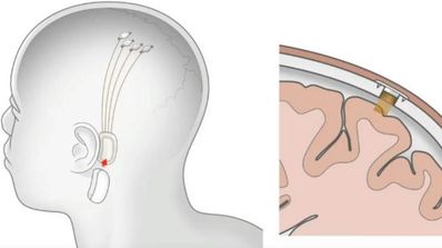 chip cerebral elon musk neuralink